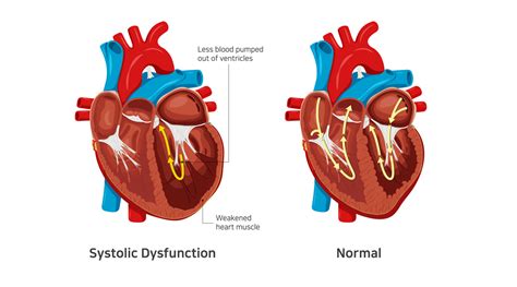 systolic heart failure ejection